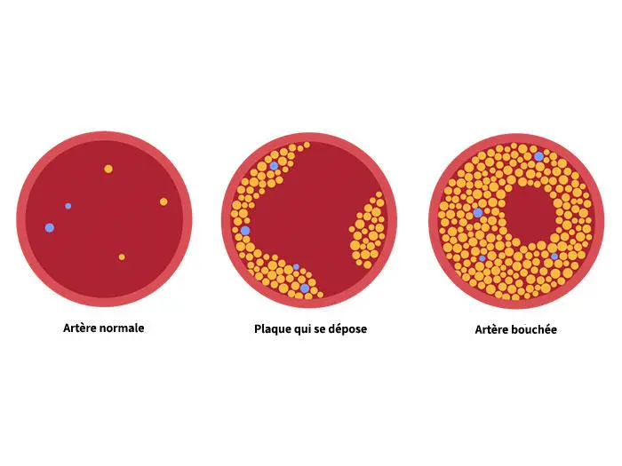 Illustration montrant, en trois étapes, à quoi ressemblent les artères lorsque la plaque s'accumule