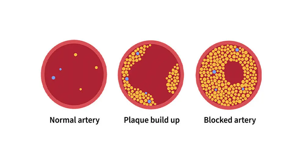 Illustration showing, three stages on what arteries look like when plaque builds up