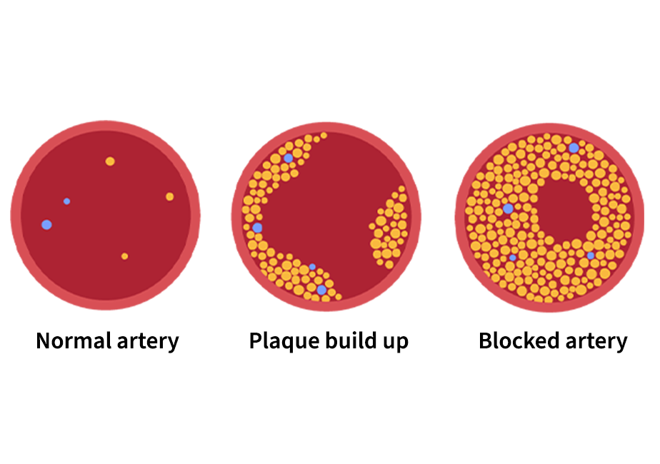 Illustration showing, three stages on what arteries look like when plaque builds up