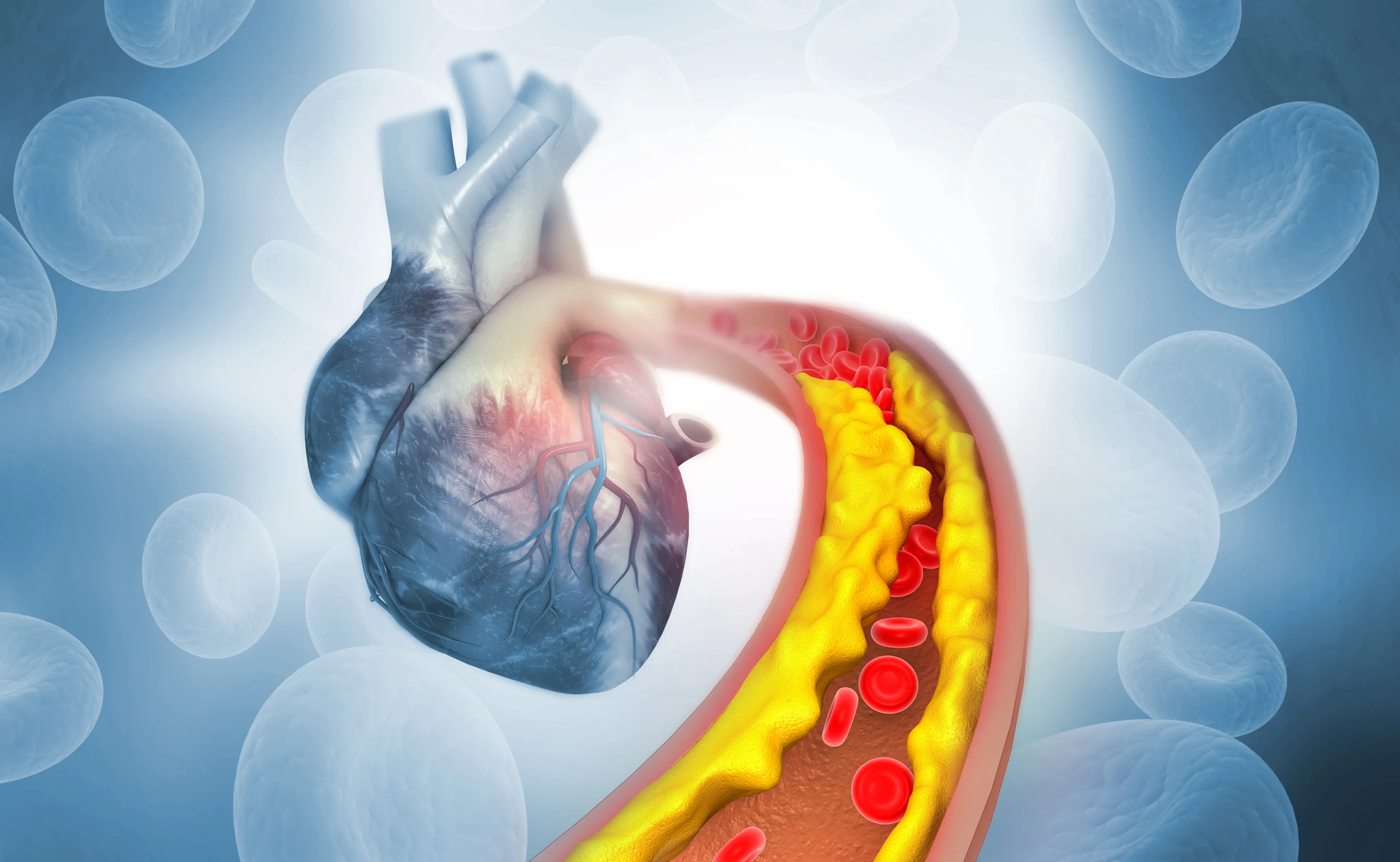 Illustration of a heart with artery coming towards you showing plaque build up within