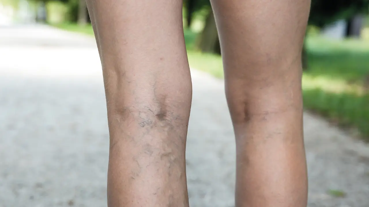 Close-up of the back of a person's knees and legs. Damaged and prominent veins are obviously visible.