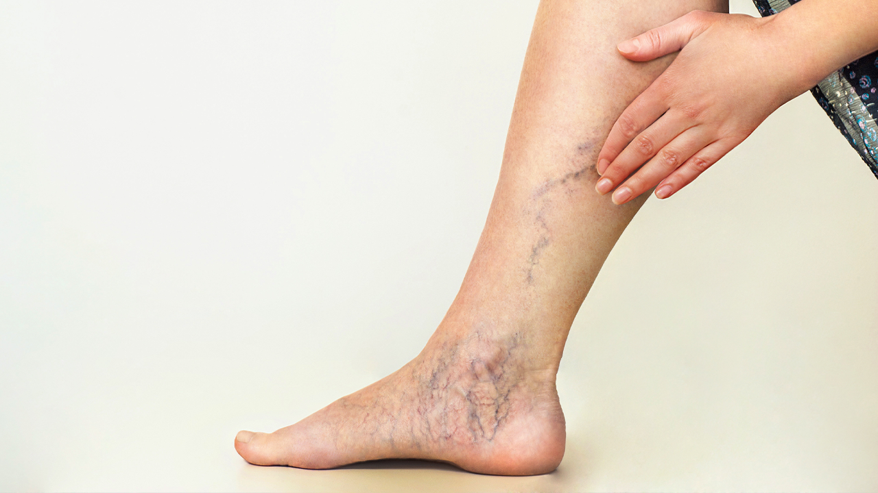 Image of a woman's leg showing the Varicose veins down the side 