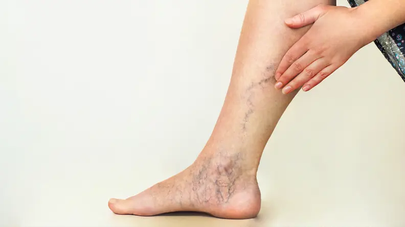 Image of a woman's leg showing the Varicose veins down the side